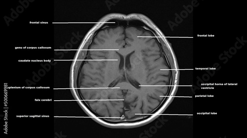 normal  brain anatomy axial t1weighted  MRI images photo