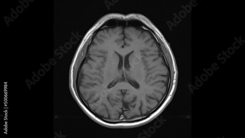 normal  brain anatomy axial t1weighted  MRI images photo