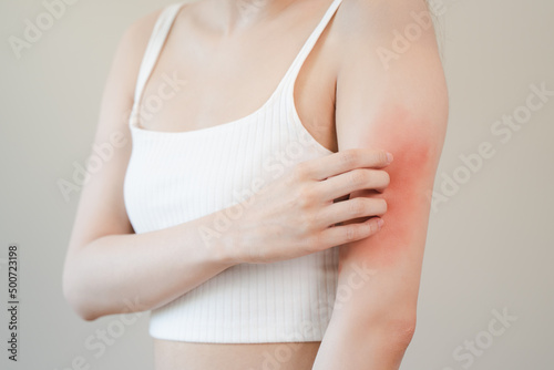 Sensitive skin allergic concept, Woman itching on her arm have a red rash from allergy symptom and from scratching. © Pormezz