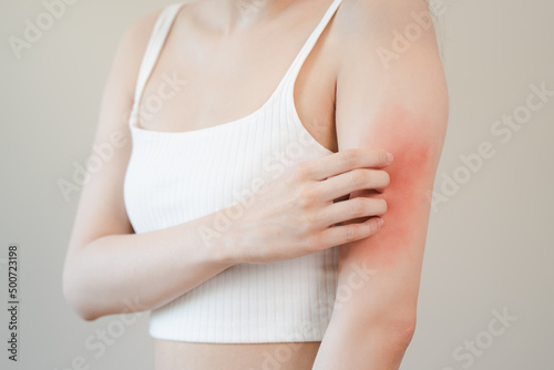 Sensitive skin allergic concept, Woman itching on her arm have a red rash from allergy symptom and from scratching.