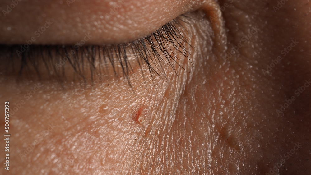 Wart skin removal. Macro shot of warts near eye on face. Papilloma on