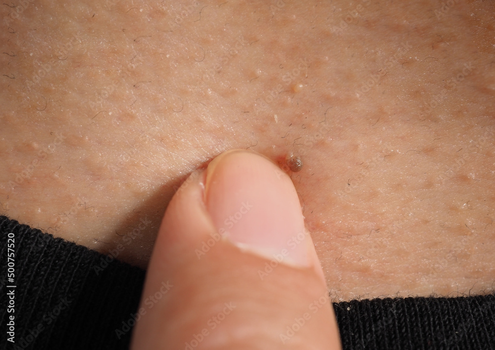Wart skin removal. Macro shot of warts near eye on face. Papilloma on skin around eye nose and neck. Birthmark Papilla or mole on skin. small hard. benign growth on the skin caused by virus. Skincare Wart skin removal. Macro shot of warts near eye on face. Papilloma on skin around eye nose and neck. Birthmark Papilla or mole on skin. small hard. benign growth on the skin caused by virus. Skincare