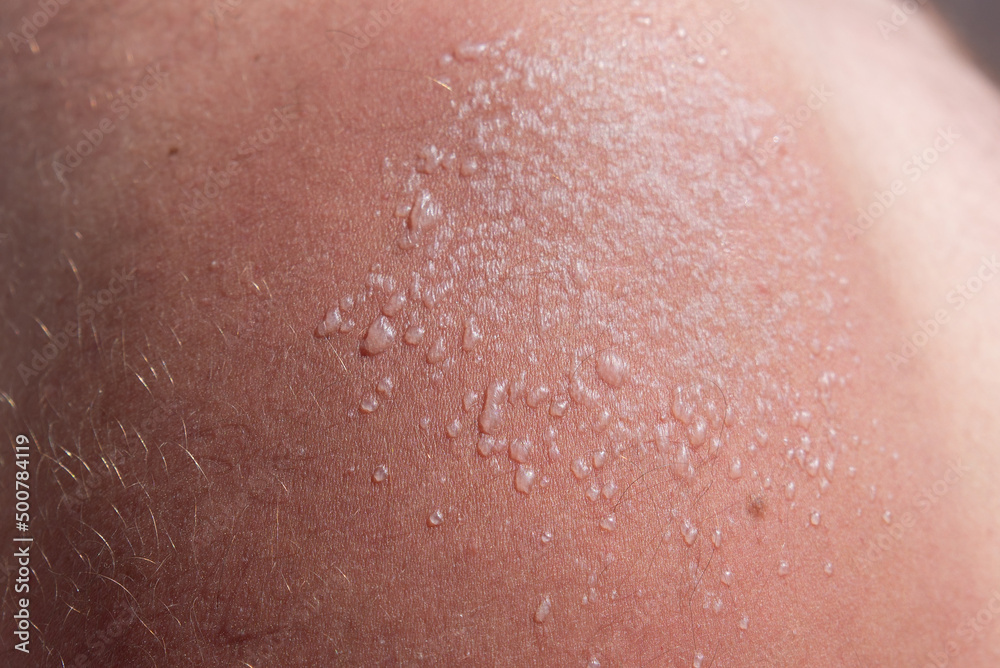 Fototapeta premium fresh sunburn on a man's shoulder. use uv protection
