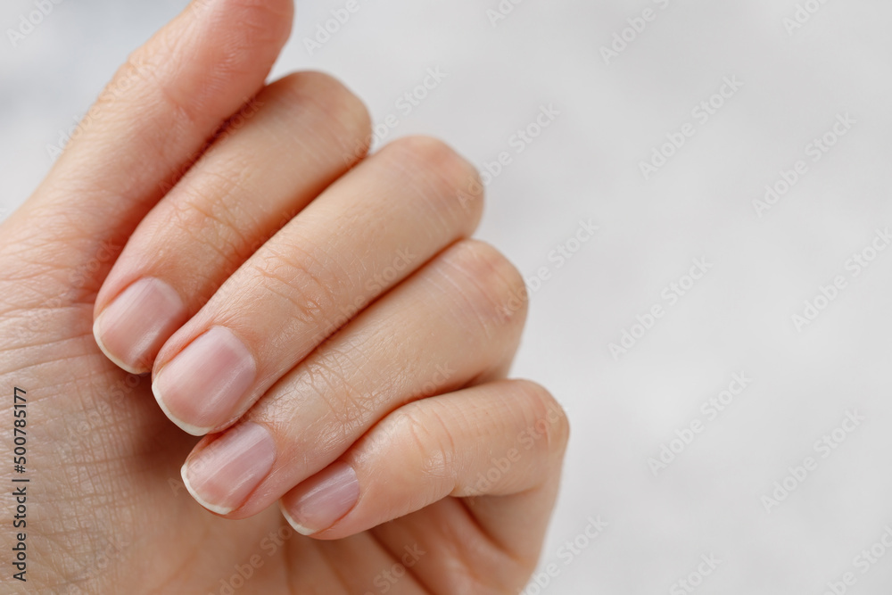 Fingernail Health – Nutrition for Dry, Brittle Nails
