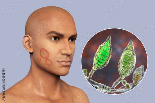 Microsporum canis fungal infection, 3D illustration photo