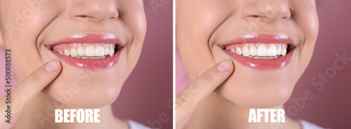 Young woman before and after gingivoplasty procedure on pink background, closeup. Banner design photo