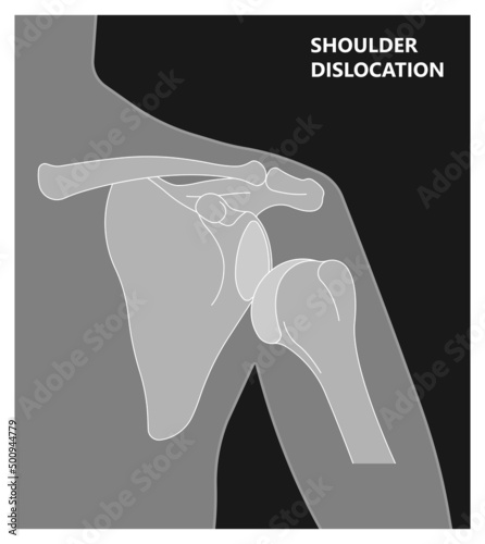Shoulder dislocation X-ray joint arm sport lesion slap hill sachs tear torn traumatic pain broken cuff sling bone falls tendon subluxed head range of motion Superior overuse clavicle separated therapy
