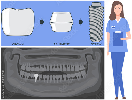 Female doctor talking about dental prosthesis structure. Implantation dentistry, stomatology. Tooth care, treatment. Dental implant creation scheme. Sequence of connection of screw, abutment and crown photo
