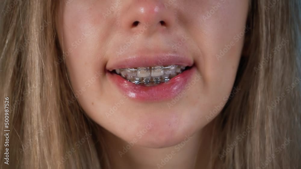 Woman smile with ceramic and metal braces. Dental teeth health care. Woman smile with ceramic and metal braces. Dental teeth health care.
