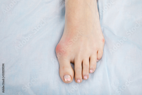 The woman suffers from inflammation of the big toe bone. Hallux valgus, bunion in foot on white background. photo