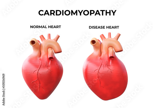 Obraz na plátně Cardiomyopathy is inflammation in the heart muscle, resulting in its enlargement