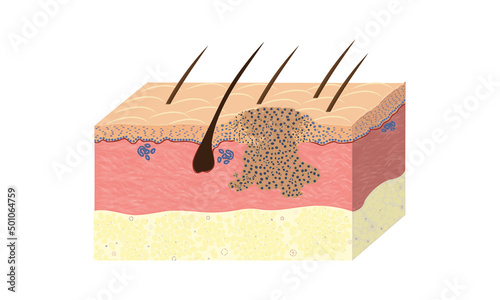 Squamous carcinoma of skin, histology, vector