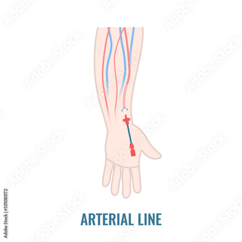 Arterial line catheter placed in the radial artery on the wrist. Critical care art line for arterial blood gas analysis and monitoring pressure. Medical vector illustration.