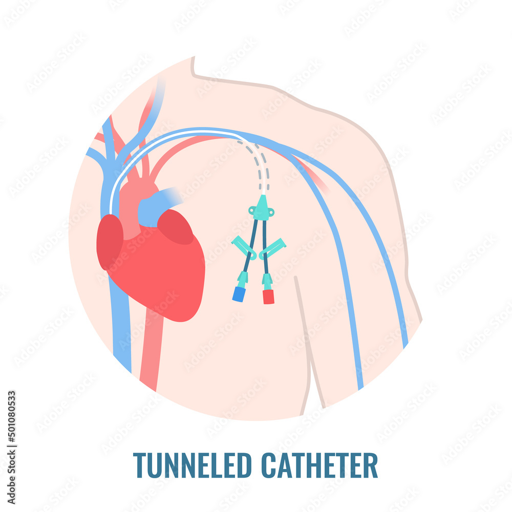 Tunneled central venous catheter placed in the subclavian vein. Man with CVC long term access device for chemotherapy infusions and blood sampling. Central line tube close up. Vector illustration. - obrazy, fototapety, plakaty 