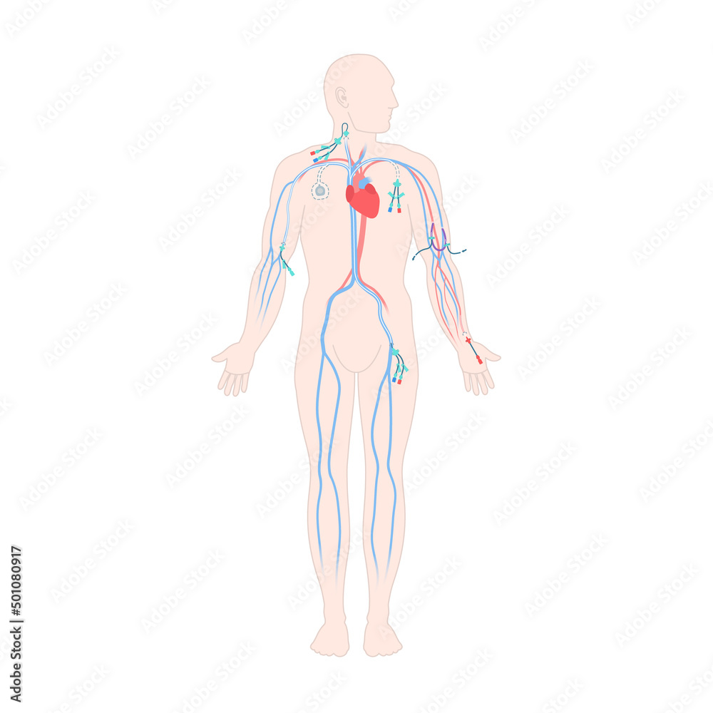 Central venous catheter placement sites shown on the male body. Types of central lines. Man with CVC access devices. PICC, arterial line, implantable port for infusion. Medical vector illustration. Central venous catheter placement sites shown on the male body. Types of central lines. Man with CVC access devices. PICC, arterial line, implantable port for infusion. Medical vector illustration.