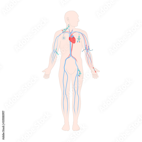 Central venous catheter placement sites shown on the male body. Types of central lines. Man with CVC access devices. PICC, arterial line, implantable port for infusion. Medical vector illustration.