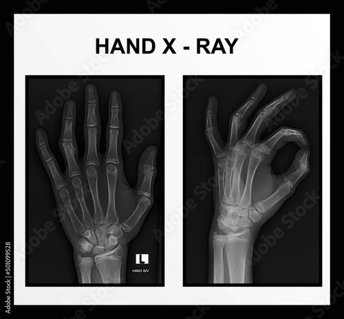X RAY OF HAND