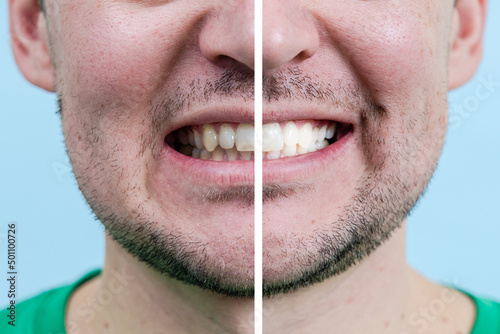 Man Teeth Before And After Whitening. Dentist work photo