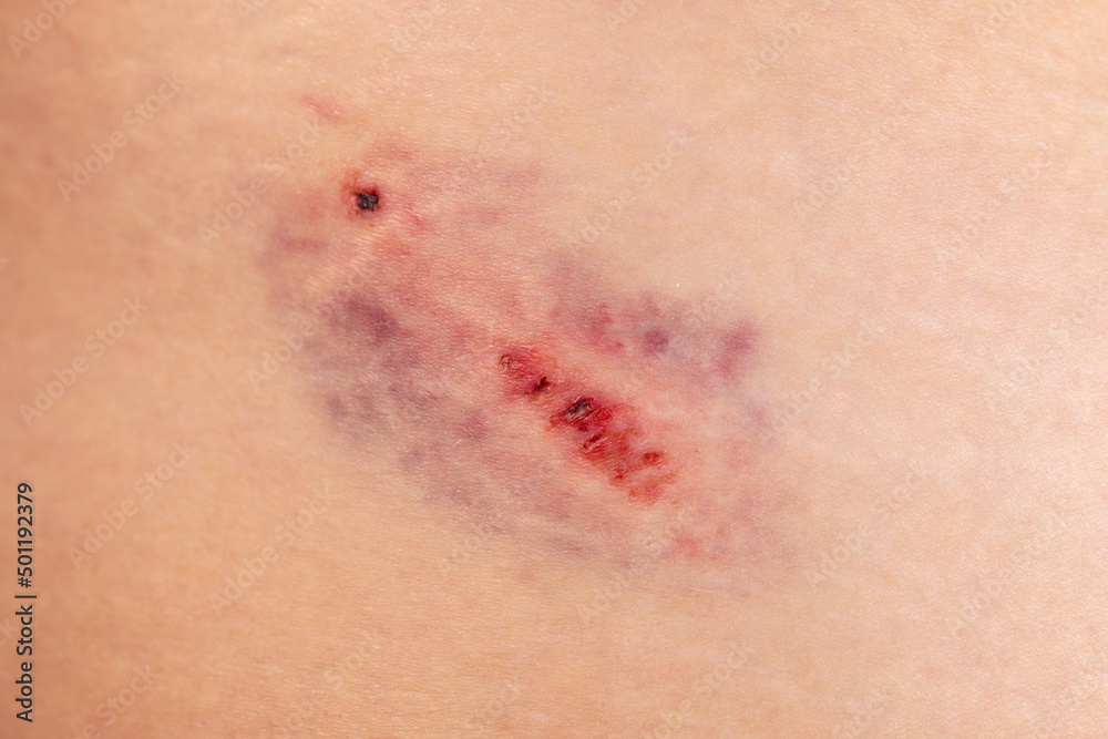 Fototapeta premium Closeup Bruise on wounded woman leg skin. Domestic violence. Large bruise on the thigh of a woman. Gender violence concept