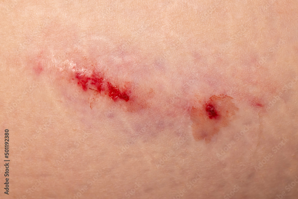 Bruise Large bruise Injection bruises Doctor and patient Bruised Bruise Large bruise Injection bruises Doctor and patient Bruised