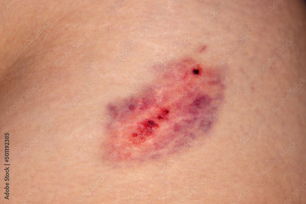 Closeup Bruise on wounded woman leg skin. Domestic violence. Large bruise on the thigh of a woman. Gender violence concept