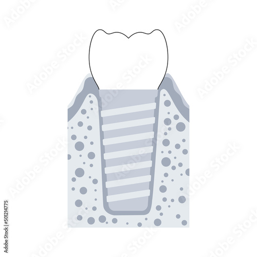 Dental implant procedure