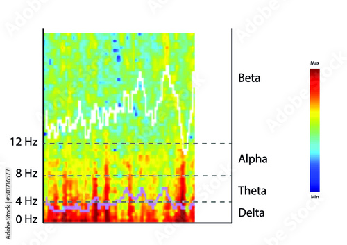 Colour density spectral array (DSA). Spectrogram delivery from EEG. 