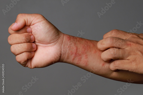 Close up allergic rash dermatitis eczema skin of patient wrist. photo
