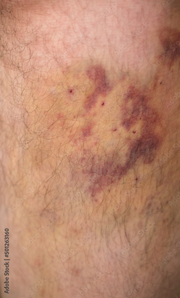 Large hematoma on the leg after a medical operation.