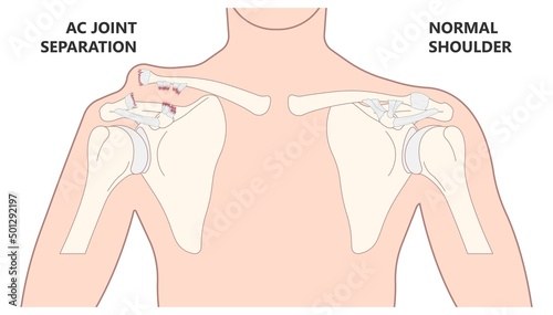 Separation dislocation the AC joint fall shoulder bump bruise torn cuff tear nerve bone broken Trauma pain arc arm sport medicine Neer FOOSH test Grade X ray Brace arthroscopy recovery range of motion photo