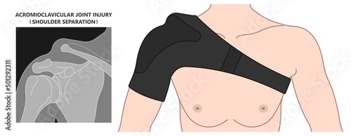 Separation dislocation the AC joint fall shoulder bump bruise torn cuff tear nerve bone broken Trauma pain arc arm sport medicine Neer FOOSH test Grade X ray Brace arthroscopy recovery range of motion