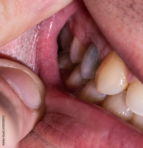 A dark tooth in a man's mouth after injury. Tooth decay by caries, dentistry. Macro