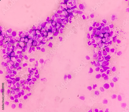 Chronic myeloid leukemia cells or CML, Microscopic examination show the increased and unregulated growth of myeloid cells in blood. photo