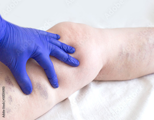 The doctor examines the leg of a patient who has varicose veins and venous thrombosis. Varicose veins treatment, close-up
