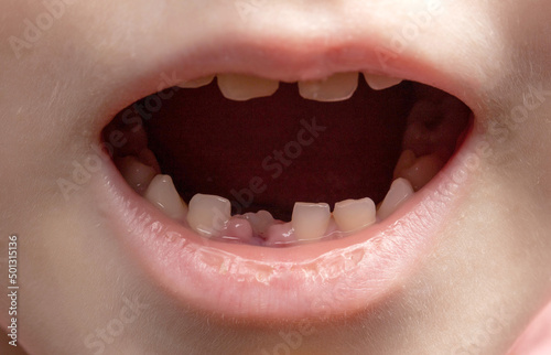 The open mouth of a child without one tooth. Loss of milk teeth. Close-up, deciduous teeth