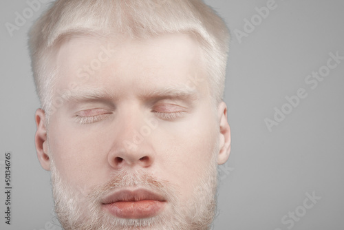 фотографія Albinism, abnormal deviations concept