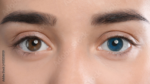 Woman with different colors of eyes, closeup. Heterochromia iridis