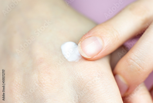 Woman applying hands cream. Irritated, problem skin of hands. Dermatology concept. Close up.