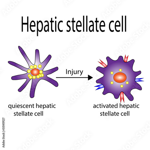 Hepatic stellate cell activation. Hepatic fibrosis