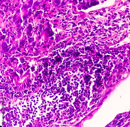 Tissue from terminal ileum: Chronic nonspecific ileitis or inflammation of the ileum, is often caused by Crohn's disease. inflammatory bowel disease (IBD). photo