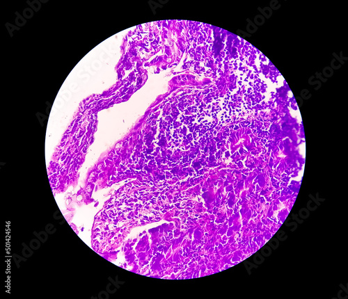 Tissue from terminal ileum: Chronic nonspecific ileitis or inflammation of the ileum, is often caused by Crohn's disease. inflammatory bowel disease (IBD).