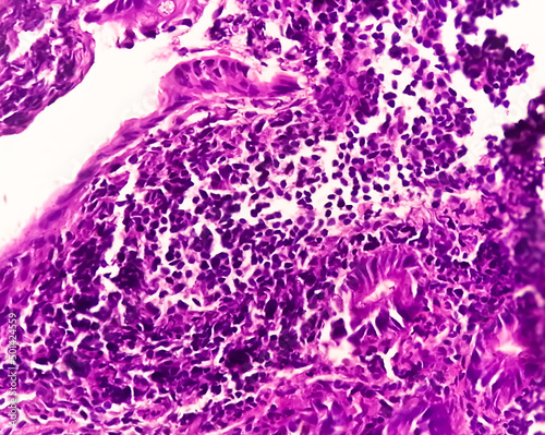 Tissue from terminal ileum: Chronic nonspecific ileitis or inflammation of the ileum, is often caused by Crohn's disease. inflammatory bowel disease (IBD). photo