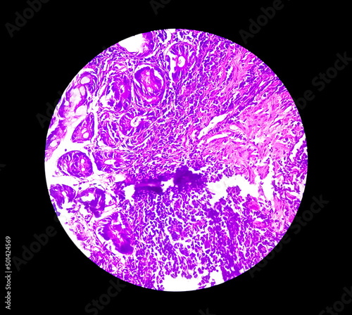 Tissue from terminal ileum: Chronic nonspecific ileitis or inflammation of the ileum, is often caused by Crohn's disease. inflammatory bowel disease (IBD).