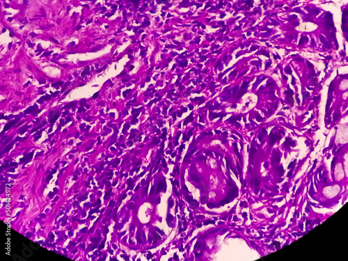 Tissue from terminal ileum: Chronic nonspecific ileitis or inflammation of the ileum, is often caused by Crohn's disease. inflammatory bowel disease (IBD). photo