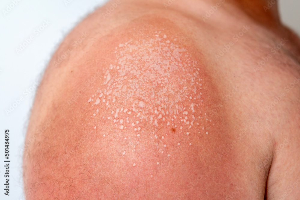 Fototapeta premium fresh sunburn bubbles on a man's shoulder. use uv protection