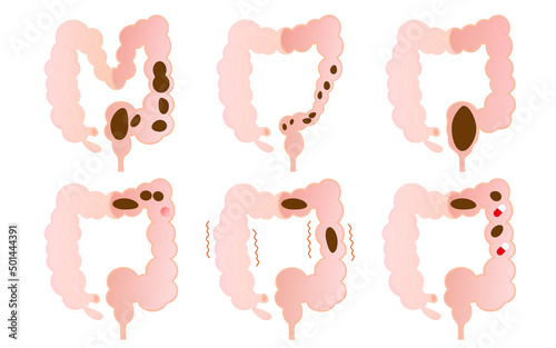 Vector illustration set of constipation types.