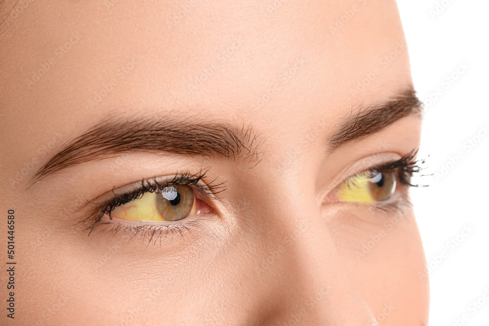 Naklejka premium Young woman with yellow eyes on white background, closeup. Hepatitis symptom