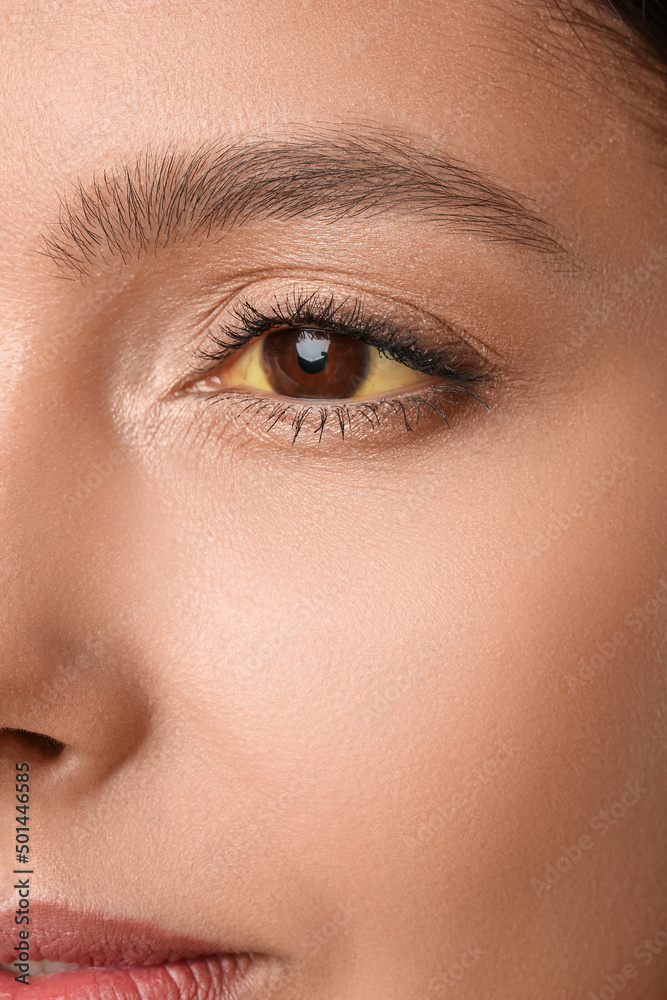 Obraz premium Young woman with yellow eyes, closeup. Hepatitis symptom