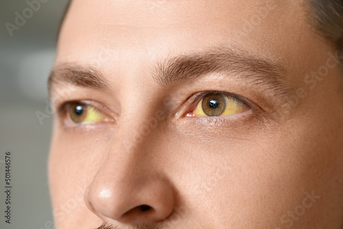Man with yellow eyes, closeup. Hepatitis symptom photo