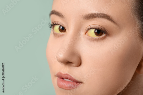 Young woman with yellow eyes on color background, closeup. Hepatitis symptom